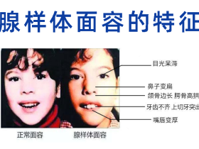 儿童腺样体肥大的症状是什么样子的！！